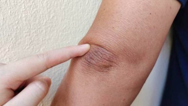 Taches brunes sur les coudes, la technique naturelle et efficace pour toutes les éliminer