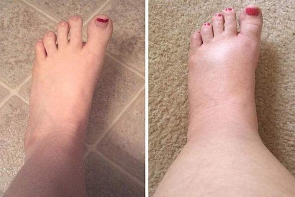 Un Remède Incontournable Contre Les Pieds Gonflés Avec La Chaleur