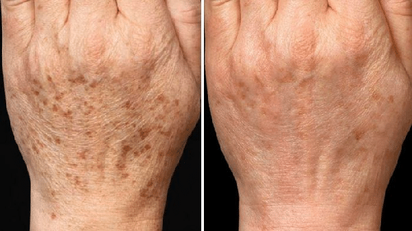 Voici Comment Rajeunissez vos Mains et Réduisez les Imperfections avec un Blanc d’œuf
